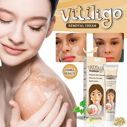 Natural Vitiligo Cream – image 2