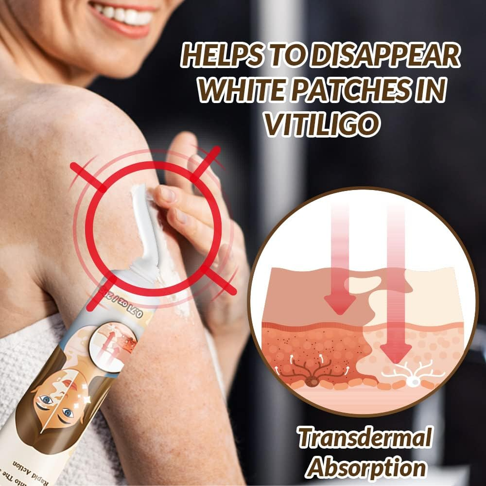 Natural Vitiligo Cream – image 5