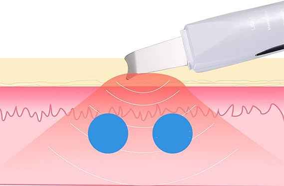 Face Blackhead Remover – side view
