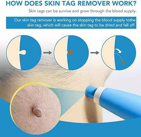 Skin Tag Remover Kit – side view