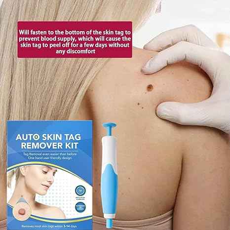 Skin Tag Remover Kit – detail view