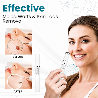 Non-Invasive Mole and Wart Removal Laser Pen (قلم ليزر لإزالة الشامات والثآليل بدون جراحة)