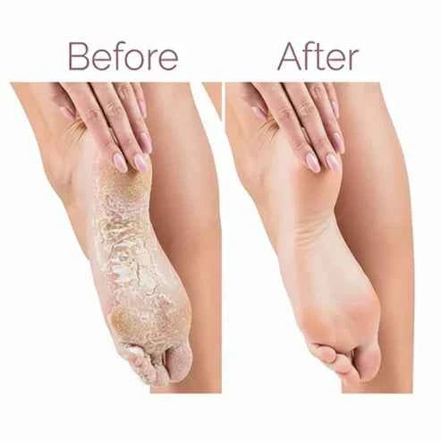 Electric Foot Callus Remover – detail view
