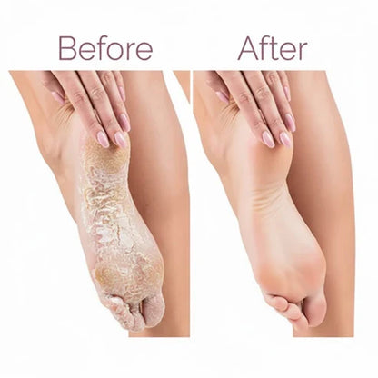 Electric Pedicure Foot File Callus Remover (مبرد كهربائي للقدمين لإزالة الجلد الميت والكالو)